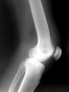 391481_knee_x-ray_2.jpg