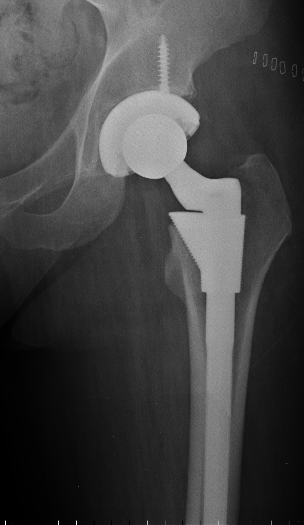 hip replacement 2.jpg